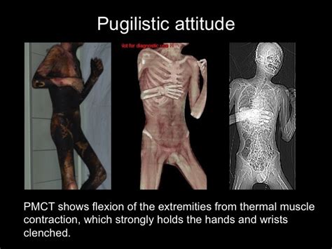 Additional types of burn infection may occur due to the use of tubes and catheters. . Pugilistic posture burn victims
